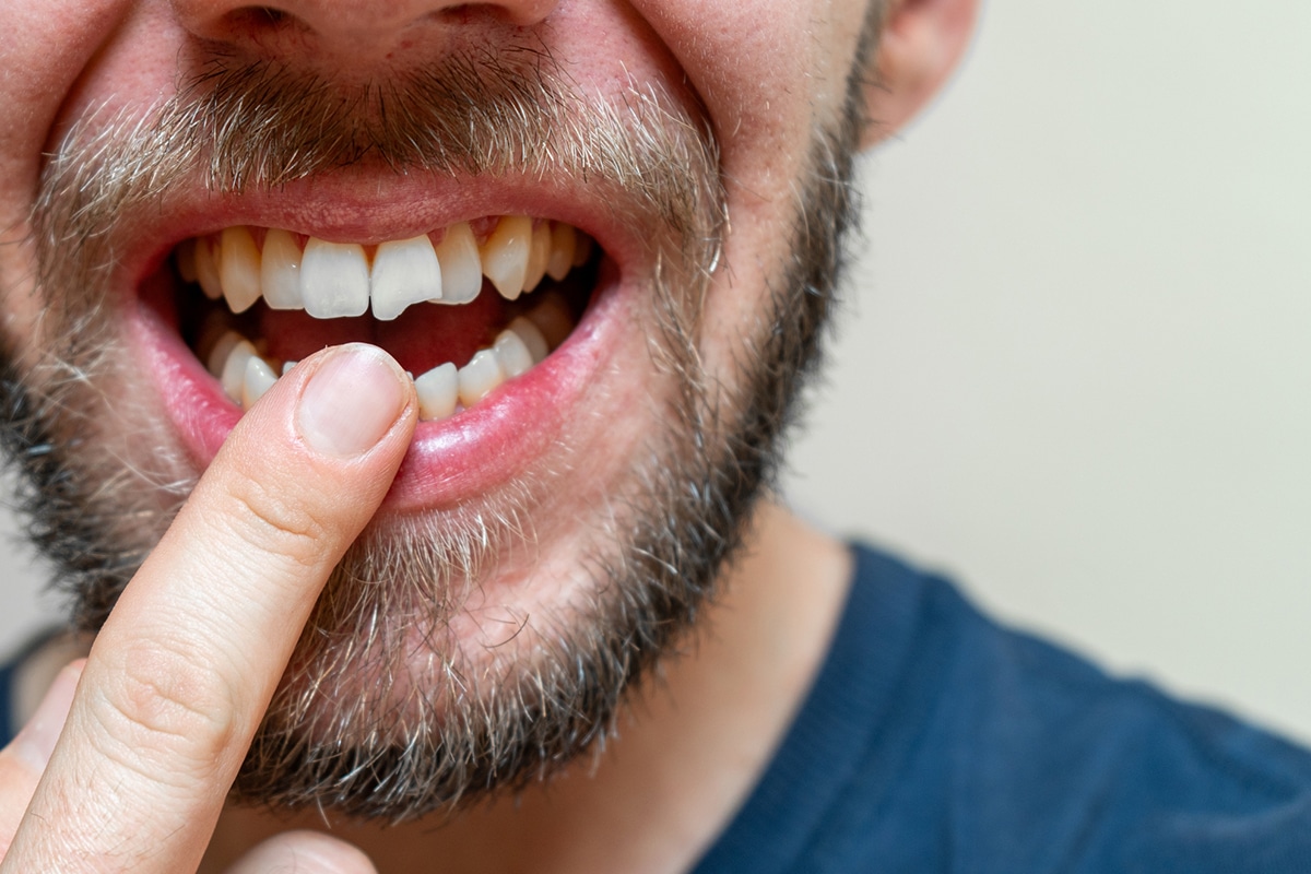 How to handle a broken tooth step by step instructions blog