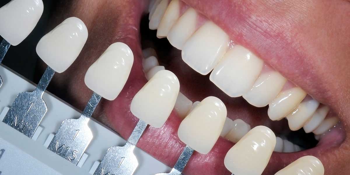 отбеливание зубов с коронкой
